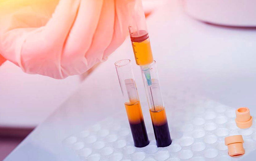 infiltrazione PRP Torino